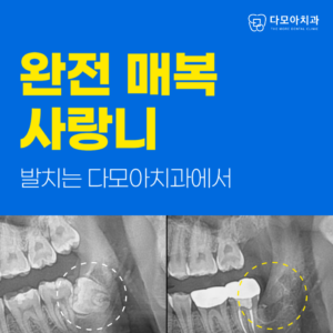 매복사랑니발치
