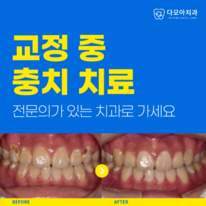 교정중_충치-001