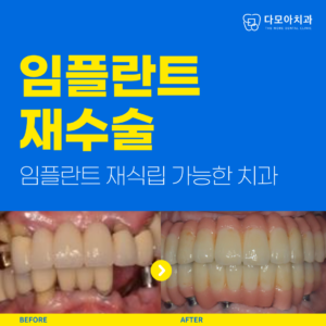 임플란트재수술-001_(1)