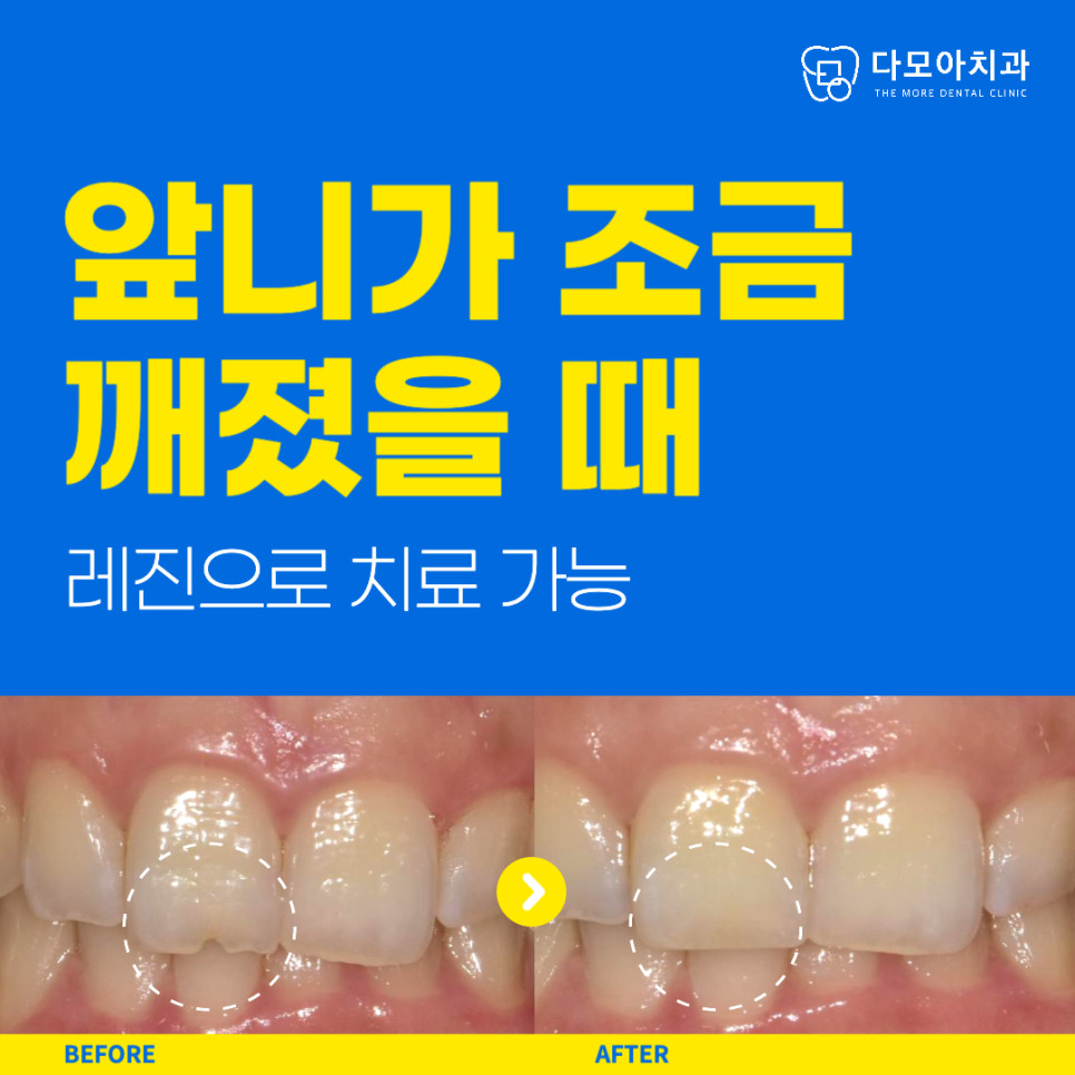 다산동치과치과앞니깨짐치료
