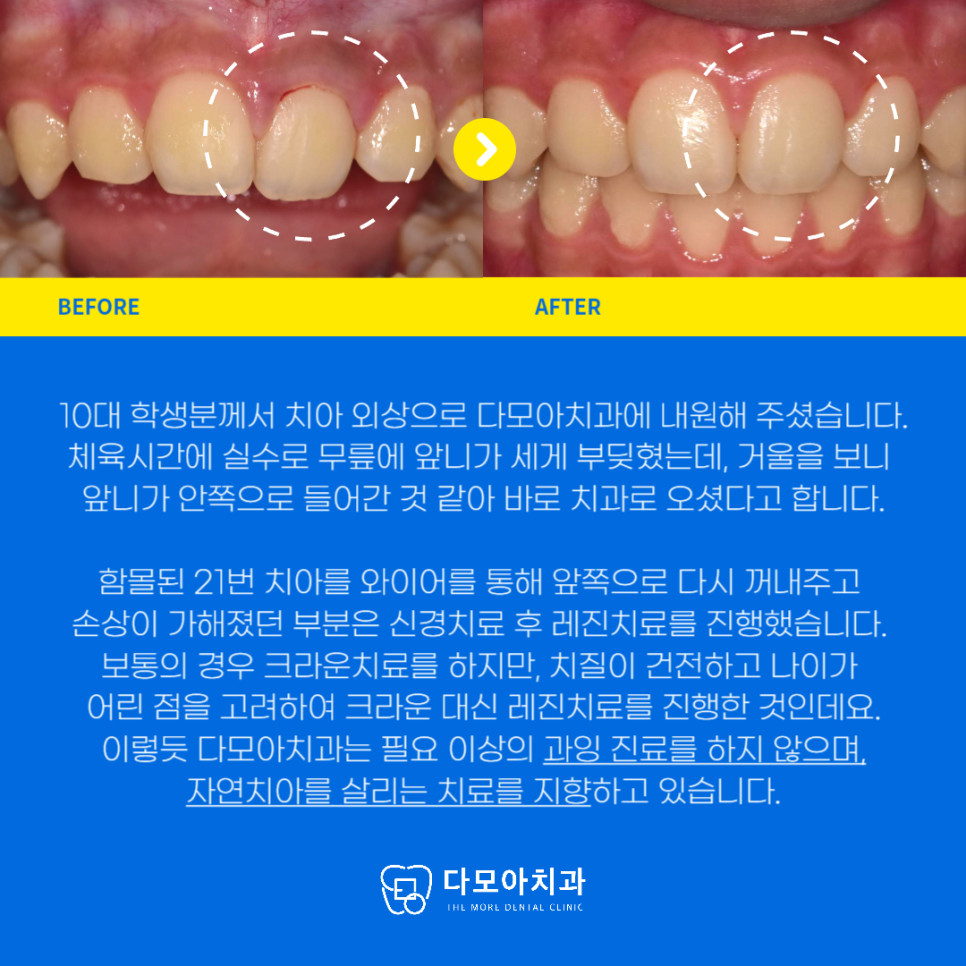 앞니탈구치과응급진료