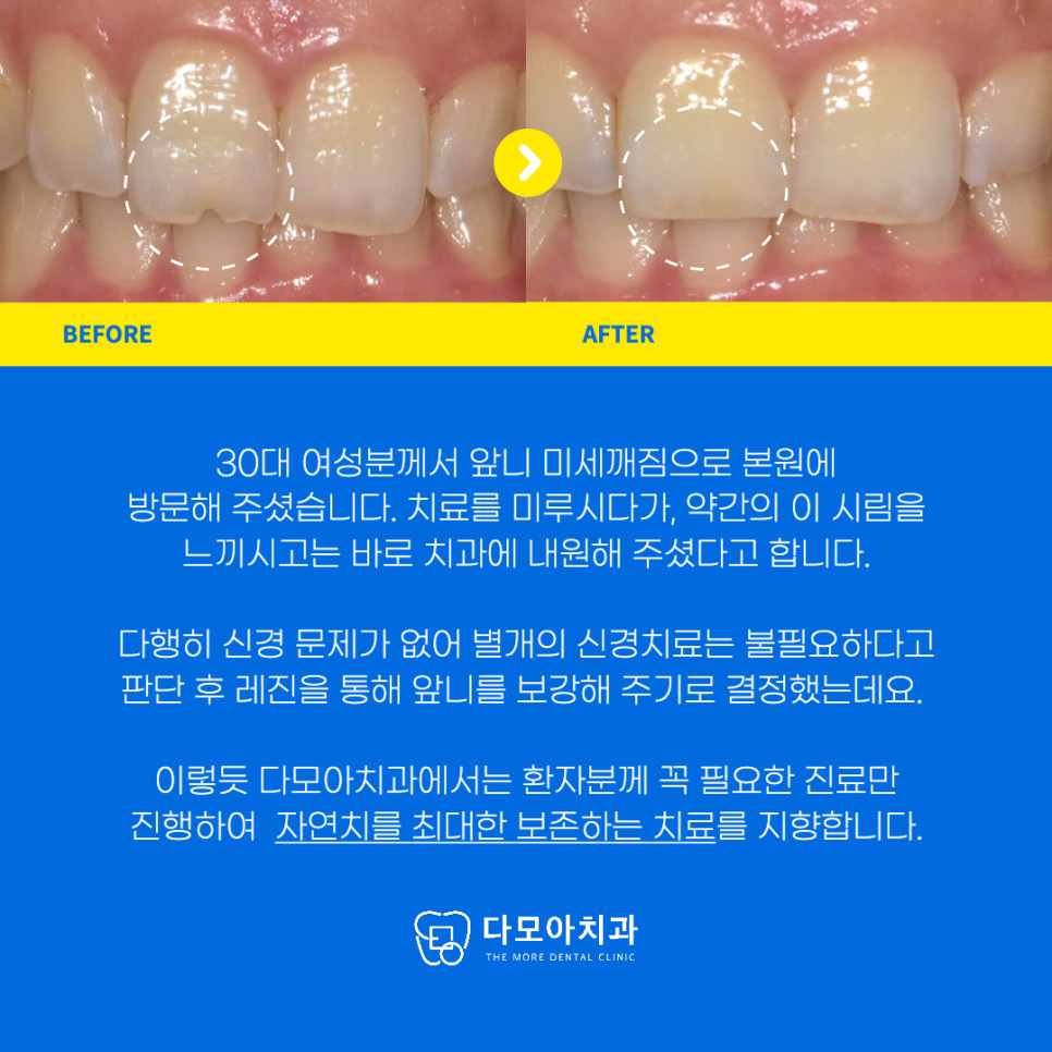 치과앞니파절레진치료