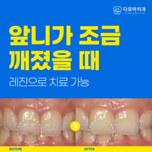 다산치과앞니깨짐치료